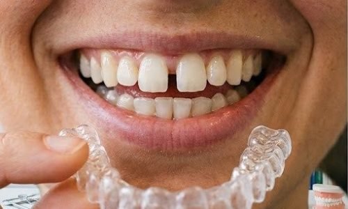 Smile Makeover – 2 bezoeken